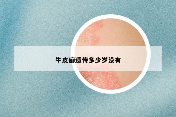 牛皮癣遗传多少岁没有