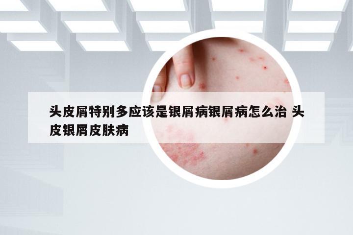 头皮屑特别多应该是银屑病银屑病怎么治 头皮银屑皮肤病