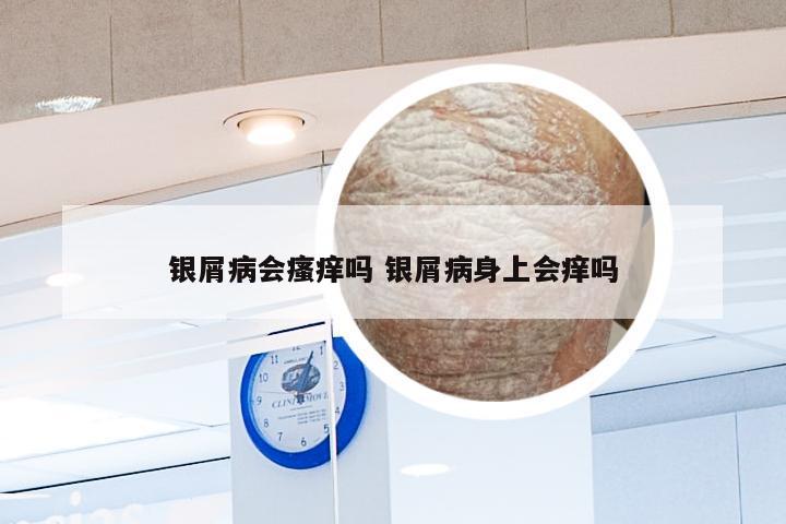 银屑病会瘙痒吗 银屑病身上会痒吗