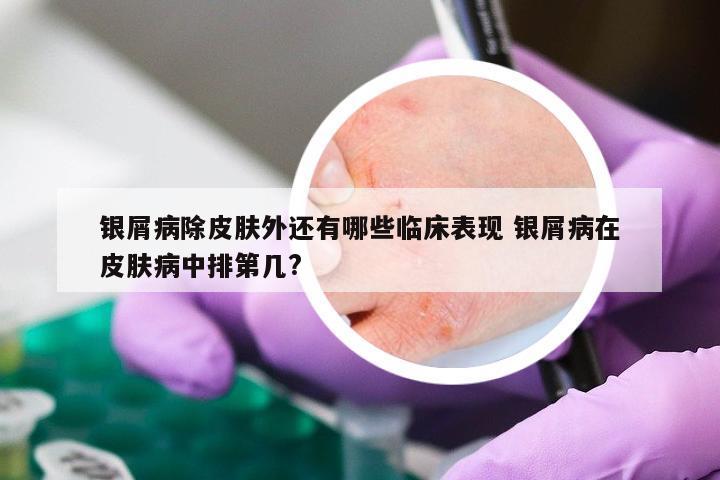 银屑病除皮肤外还有哪些临床表现 银屑病在皮肤病中排第几?