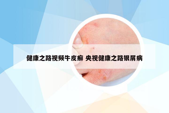 健康之路视频牛皮癣 央视健康之路银屑病