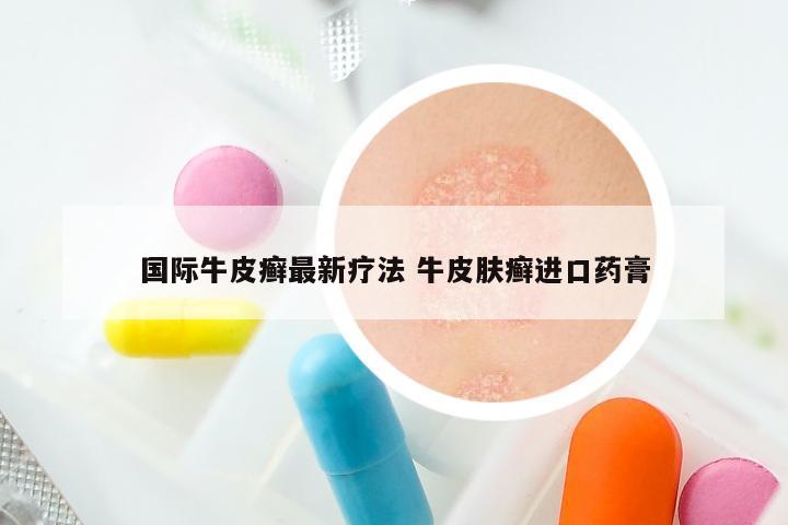 国际牛皮癣最新疗法 牛皮肤癣进口药膏