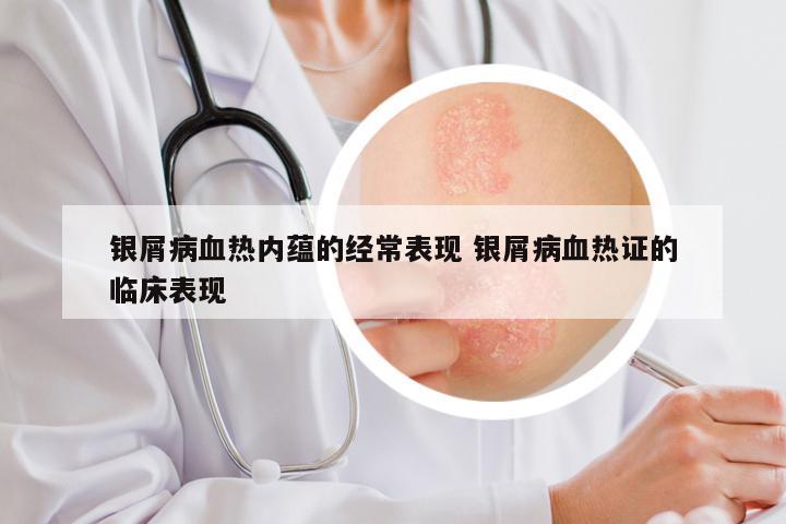 银屑病血热内蕴的经常表现 银屑病血热证的临床表现