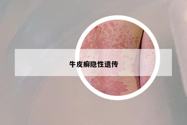 牛皮癣隐性遗传