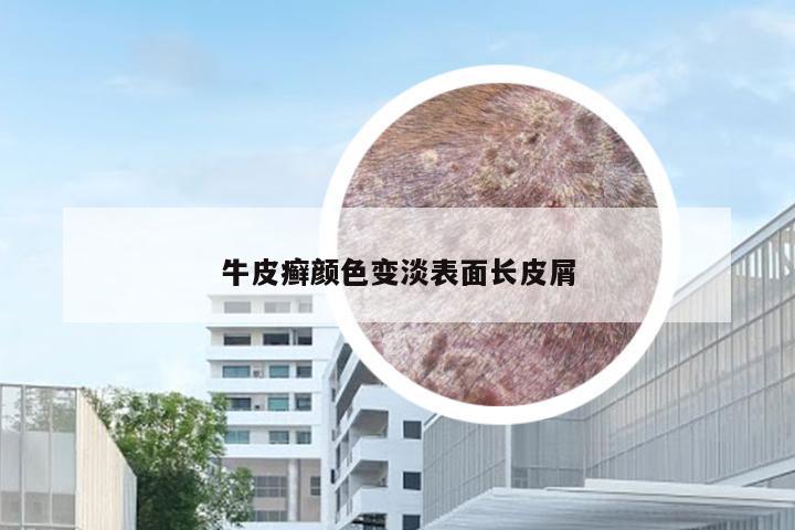 牛皮癣颜色变淡表面长皮屑