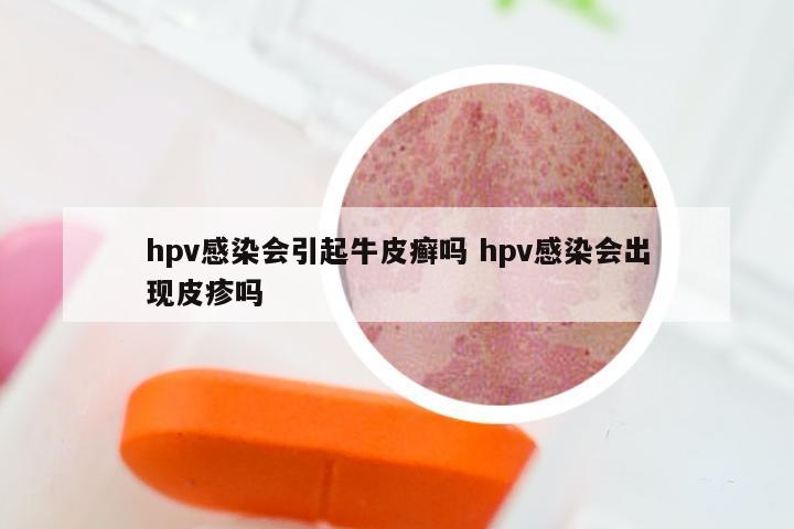 hpv感染会引起牛皮癣吗 hpv感染会出现皮疹吗