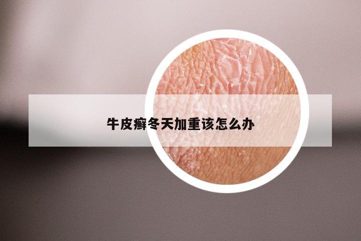 牛皮癣冬天加重该怎么办