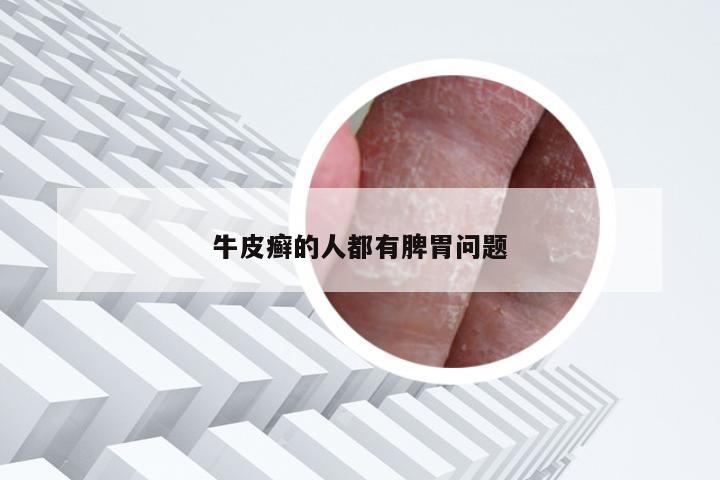 牛皮癣的人都有脾胃问题