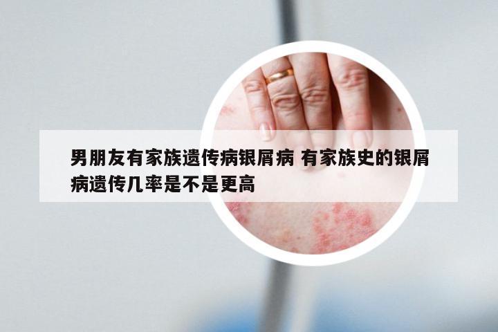 男朋友有家族遗传病银屑病 有家族史的银屑病遗传几率是不是更高