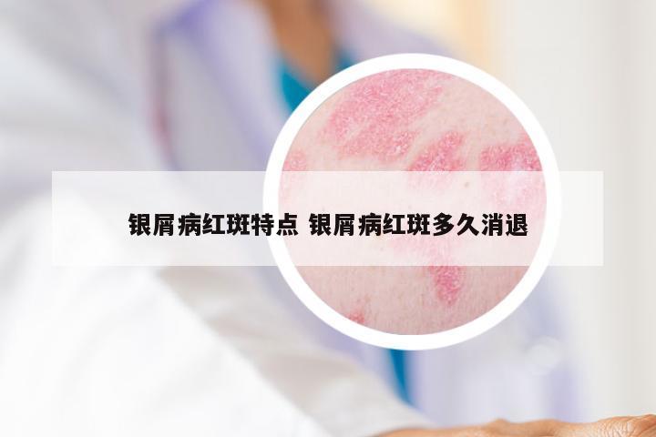 银屑病红斑特点 银屑病红斑多久消退