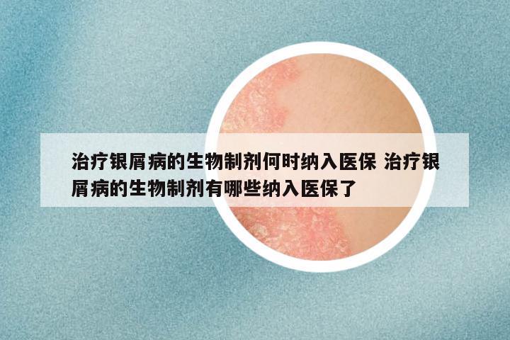 治疗银屑病的生物制剂何时纳入医保 治疗银屑病的生物制剂有哪些纳入医保了