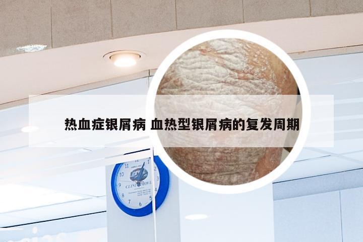 热血症银屑病 血热型银屑病的复发周期