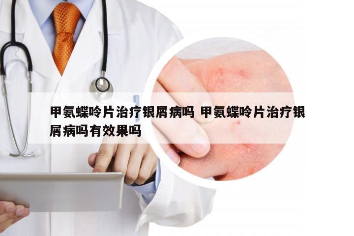 甲氨蝶呤片治疗银屑病吗 甲氨蝶呤片治疗银屑病吗有效果吗