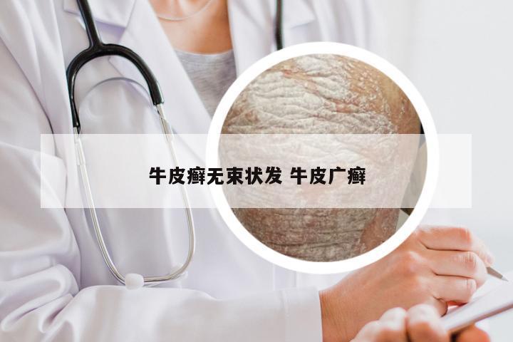 牛皮癣无束状发 牛皮广癣