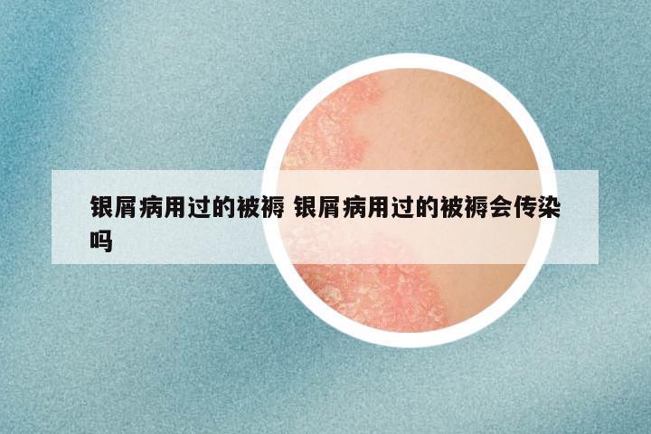银屑病用过的被褥 银屑病用过的被褥会传染吗