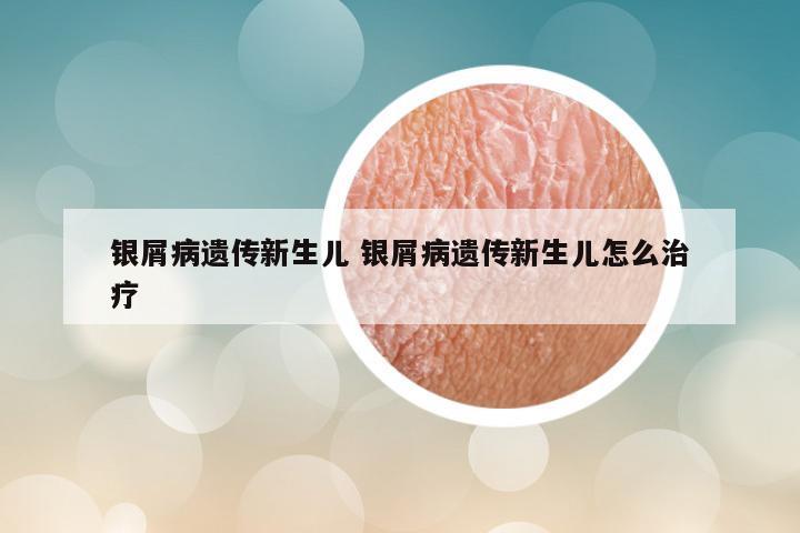 银屑病遗传新生儿 银屑病遗传新生儿怎么治疗