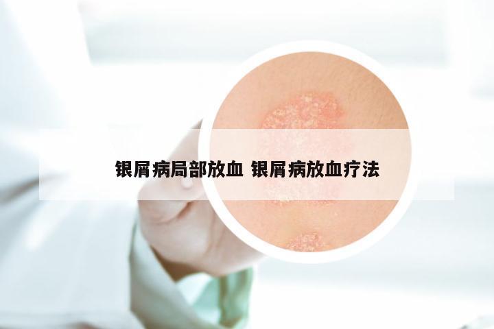银屑病局部放血 银屑病放血疗法