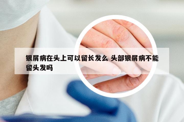 银屑病在头上可以留长发么 头部银屑病不能留头发吗