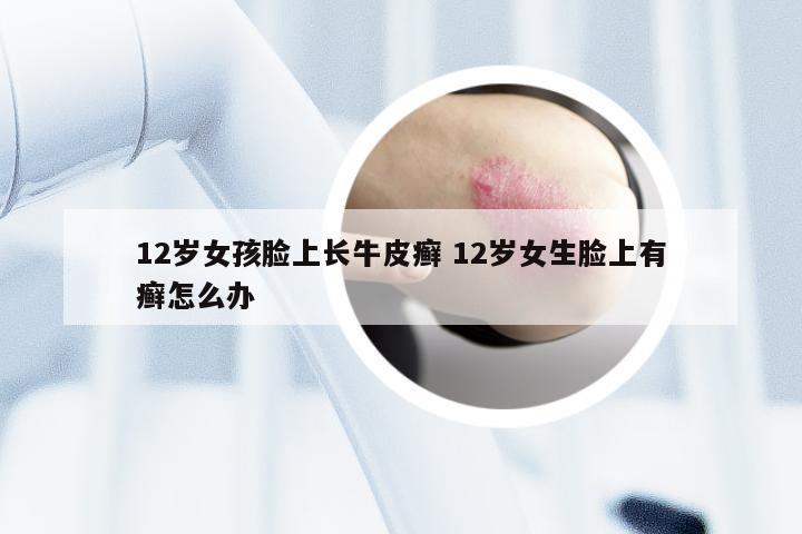 12岁女孩脸上长牛皮癣 12岁女生脸上有癣怎么办