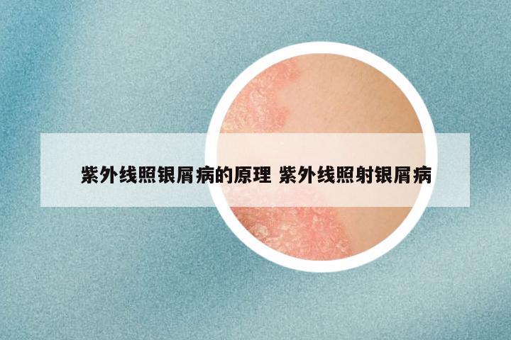 紫外线照银屑病的原理 紫外线照射银屑病