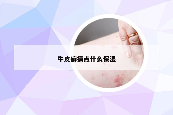 牛皮癣摸点什么保湿