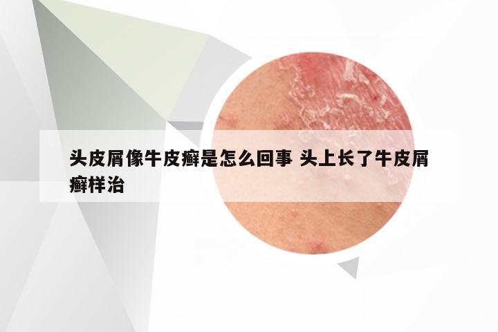 头皮屑像牛皮癣是怎么回事 头上长了牛皮屑癣样治