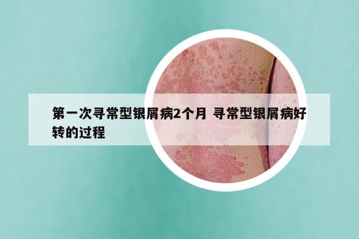 第一次寻常型银屑病2个月 寻常型银屑病好转的过程