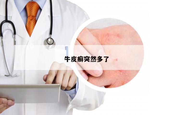 牛皮癣突然多了
