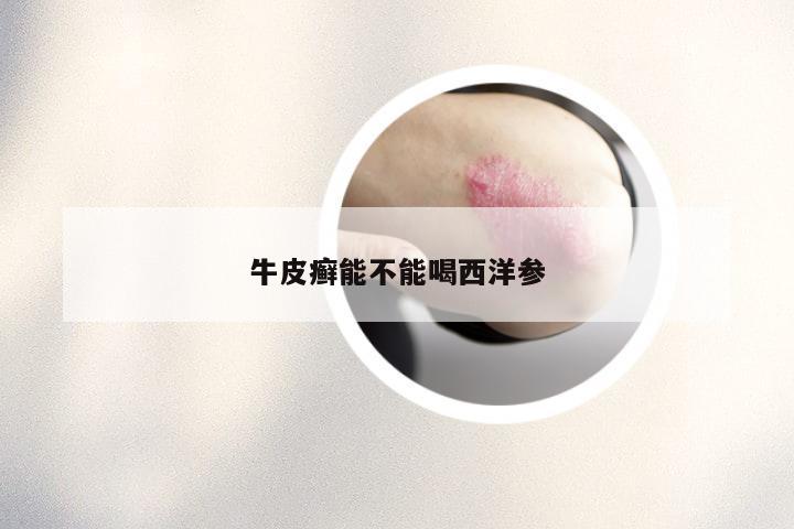 牛皮癣能不能喝西洋参