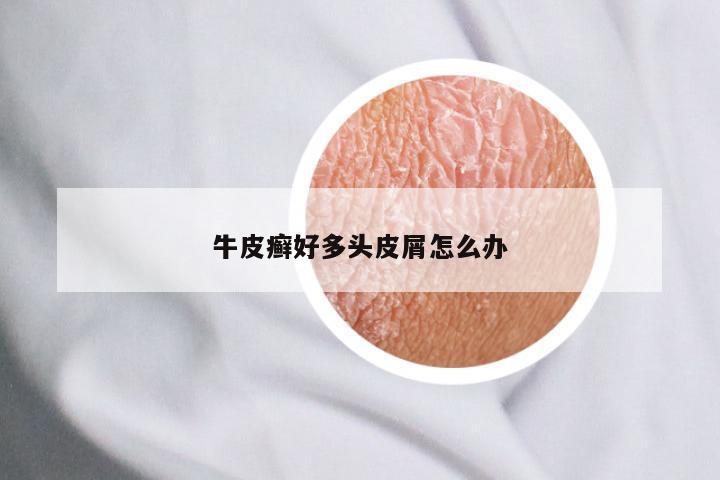 牛皮癣好多头皮屑怎么办