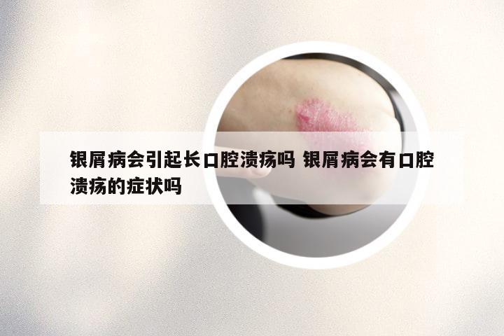 银屑病会引起长口腔溃疡吗 银屑病会有口腔溃疡的症状吗