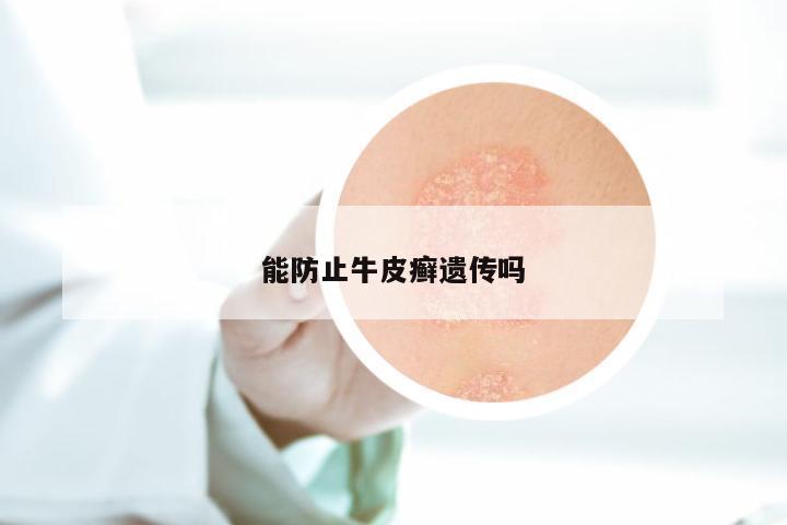 能防止牛皮癣遗传吗