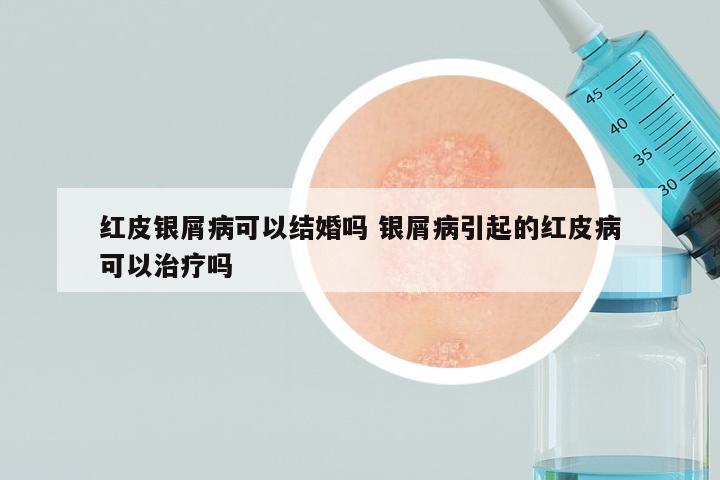 红皮银屑病可以结婚吗 银屑病引起的红皮病可以治疗吗