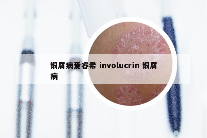 银屑病爱睿希 involucrin 银屑病