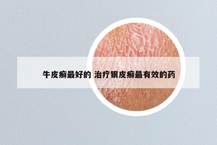 牛皮癣最好的 治疗银皮癣最有效的药