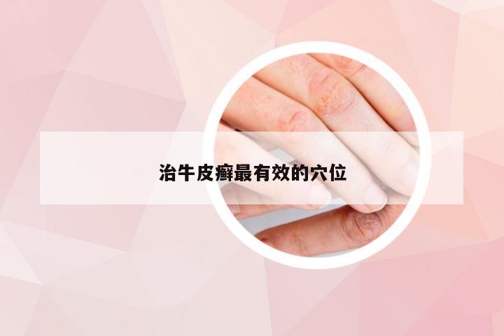 治牛皮癣最有效的穴位