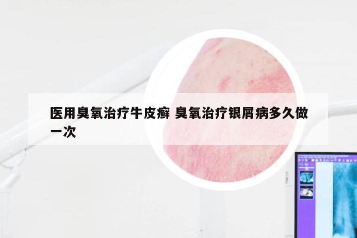 医用臭氧治疗牛皮癣 臭氧治疗银屑病多久做一次