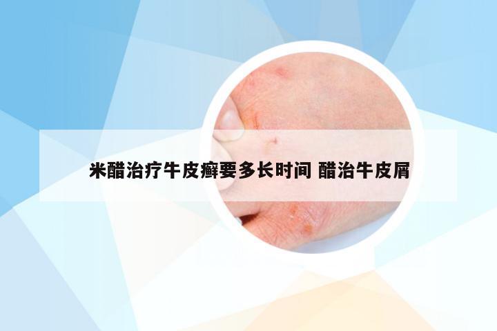 米醋治疗牛皮癣要多长时间 醋治牛皮屑