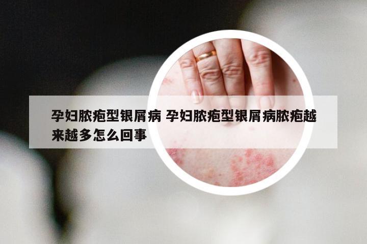 孕妇脓疱型银屑病 孕妇脓疱型银屑病脓疱越来越多怎么回事