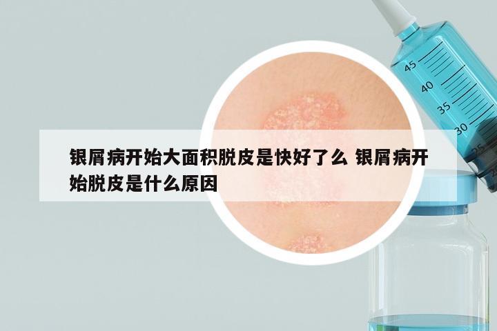 银屑病开始大面积脱皮是快好了么 银屑病开始脱皮是什么原因
