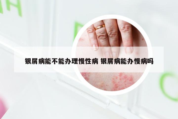 银屑病能不能办理慢性病 银屑病能办慢病吗