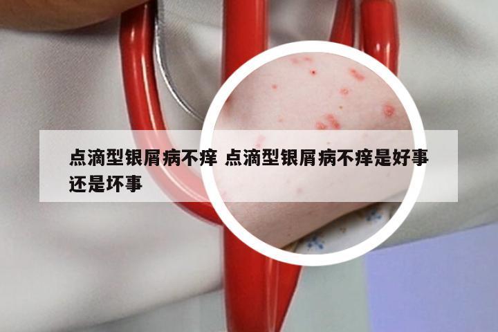 点滴型银屑病不痒 点滴型银屑病不痒是好事还是坏事