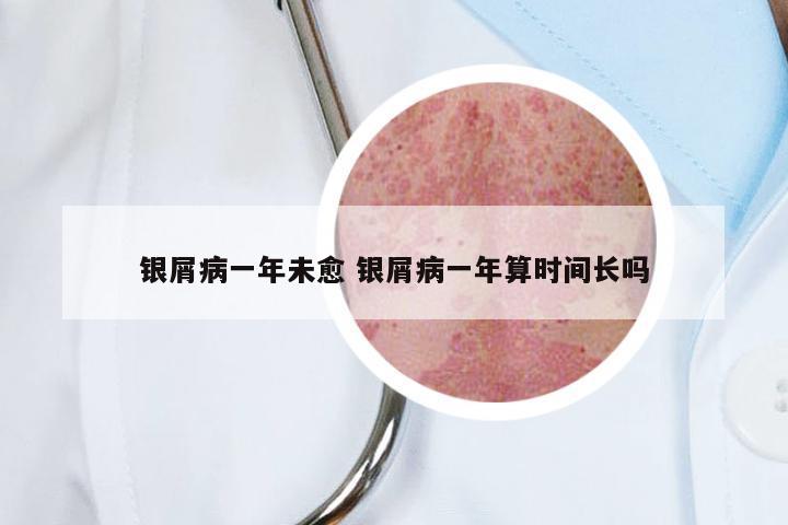 银屑病一年未愈 银屑病一年算时间长吗