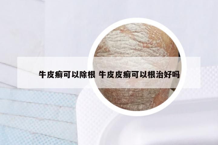 牛皮癣可以除根 牛皮皮癣可以根治好吗