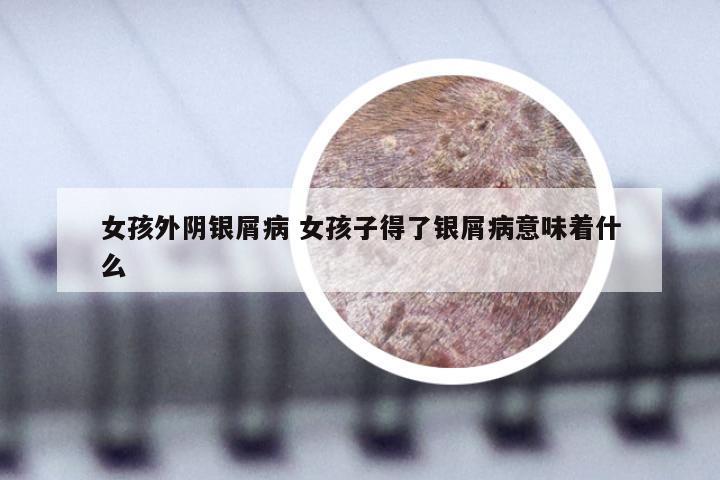 女孩外阴银屑病 女孩子得了银屑病意味着什么