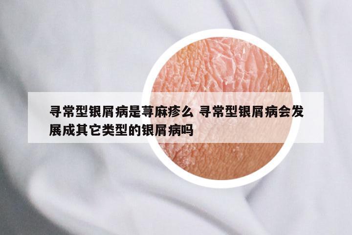 寻常型银屑病是荨麻疹么 寻常型银屑病会发展成其它类型的银屑病吗