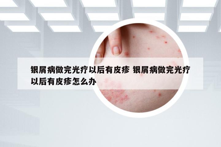 银屑病做完光疗以后有皮疹 银屑病做完光疗以后有皮疹怎么办