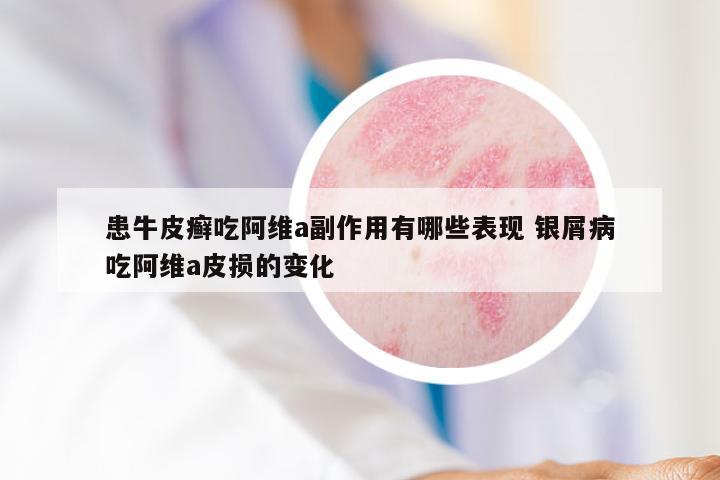 患牛皮癣吃阿维a副作用有哪些表现 银屑病吃阿维a皮损的变化