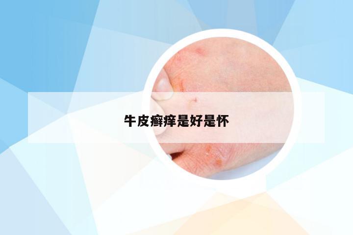 牛皮癣痒是好是怀