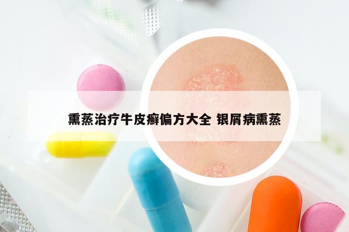 熏蒸治疗牛皮癣偏方大全 银屑病熏蒸